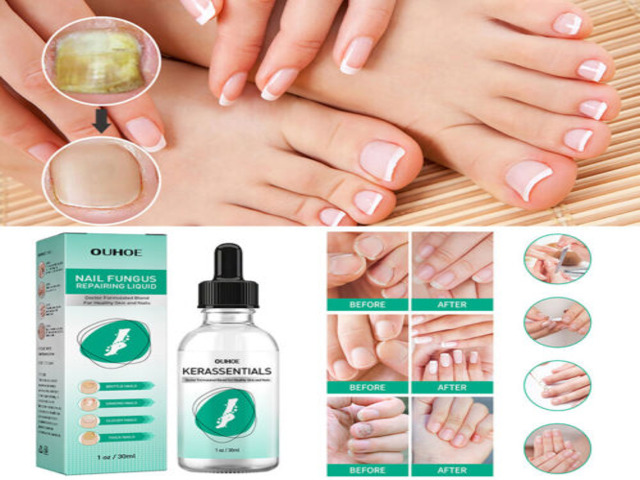 Kerassentials Reviews: Does Kerassentials Really Work for Toenail Fungus? Expert Guide & Warnings