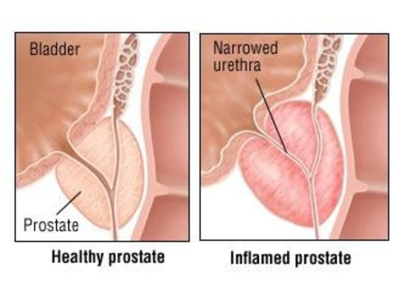 Best Prostate Health Supplements